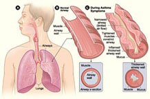 A picture of asthma airwaves