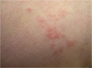 Photo of a person's arm with bed bug bites. This photo shows us how to find bed bugs. 